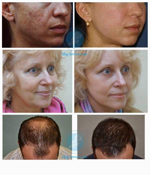 Плазмолифтинг волосистой части головы - плазмолифтинг для волос: до и после