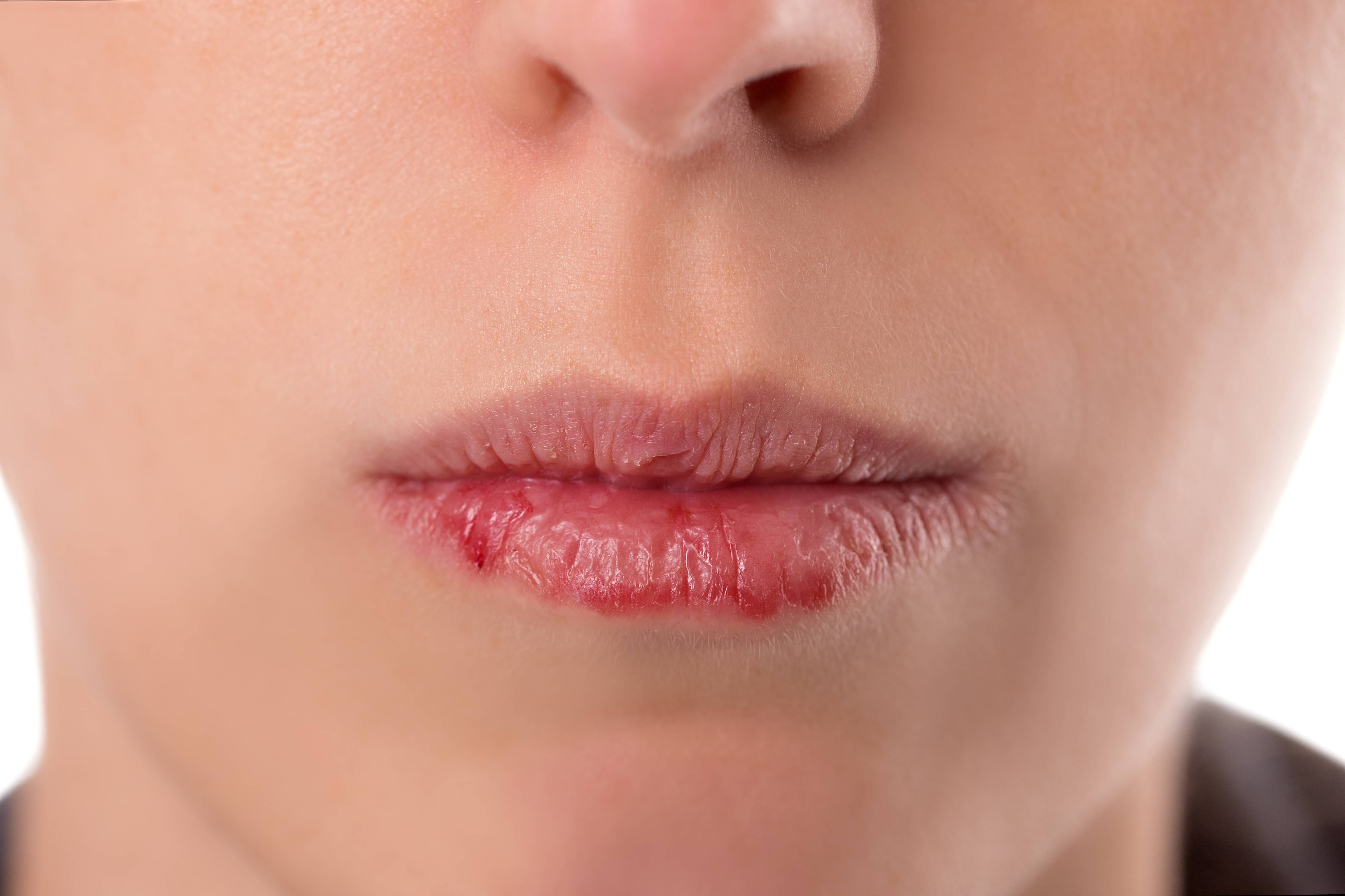 Что делать, если у ребёнка трескаются губы?