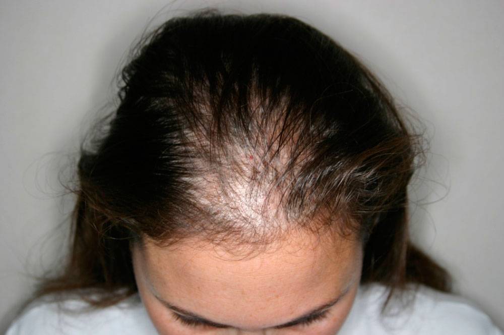 Могут ли выпадать волосы из-за пищевой аллергии