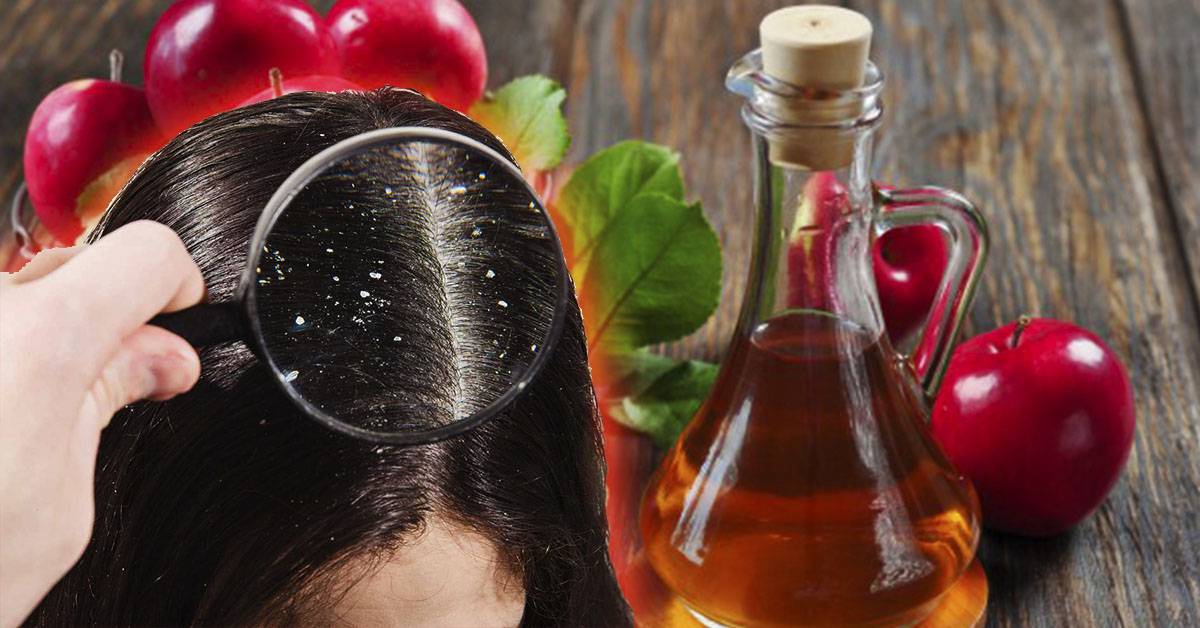 Яблочный уксус польза для волос от выпадения, от перхоти, для роста