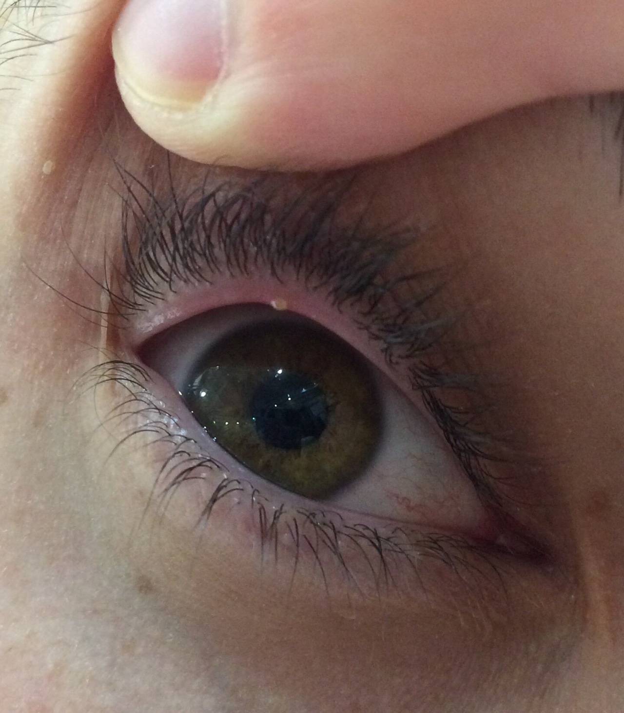 Демодекоз глаз: причины, симптомы и лечение