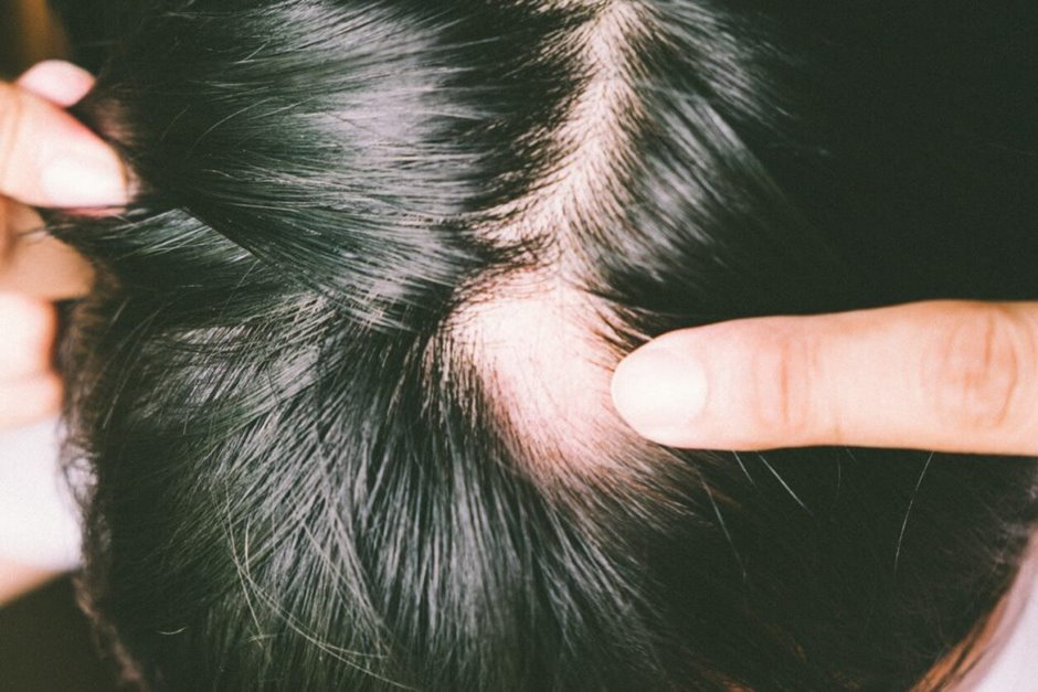 Выпадение волос у женщин фото