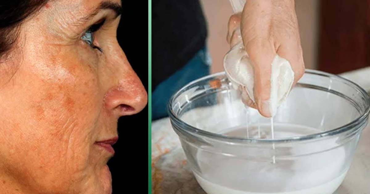 Как убрать возрастные пигментные пятна на лице