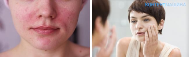 Аллергия на мейкап: как распознать и как защититься