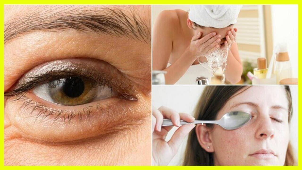 Мешки под глазами, как избавиться - косметология доктора корчагиной