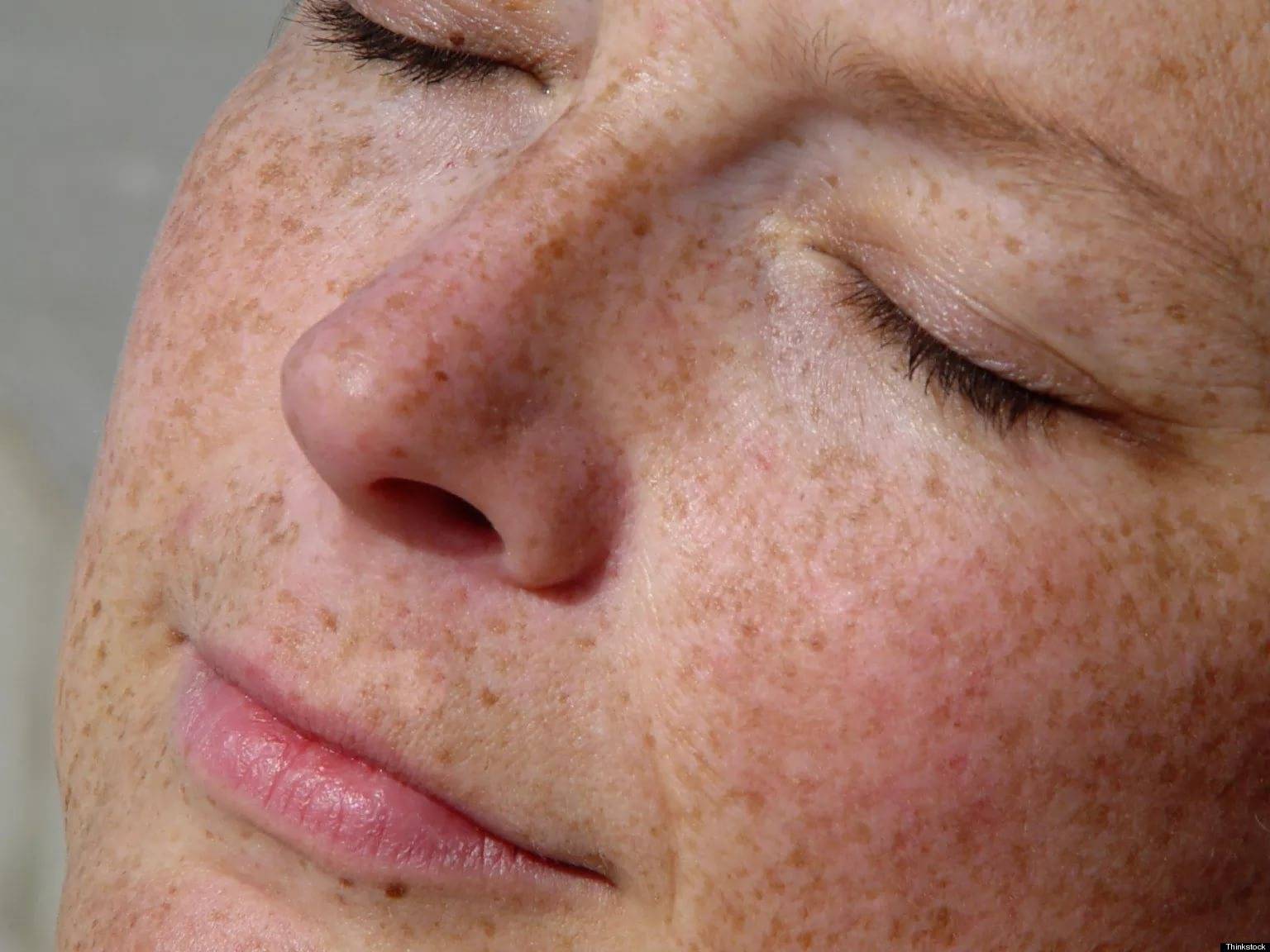 Гиперпигментация кожи: причины, симптомы, виды и методы лечения