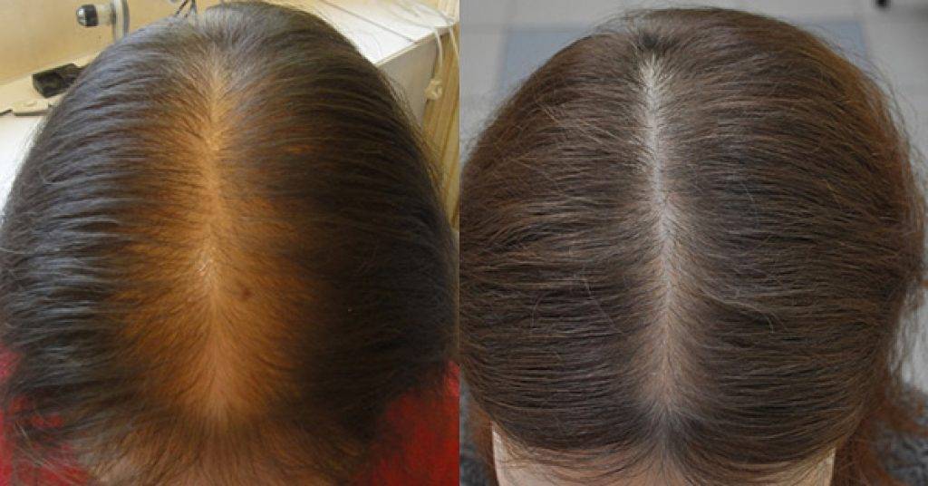 Как справиться с причинами выпадения волос у девушек