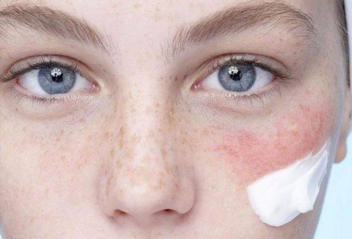 Причины аллергии на глазах «ochkov.net»