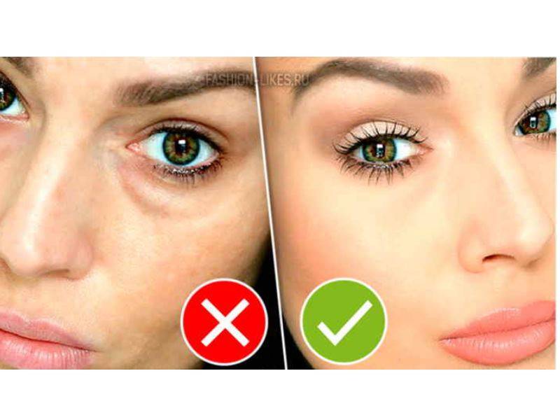 Как замазать синяк под глазом: хитрости маскировочного макияжа