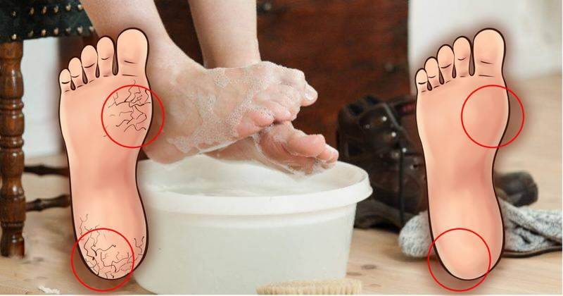 Все о лечении грибка между пальцами ног. симптомы и признаки. как выглядит и чем лечится.