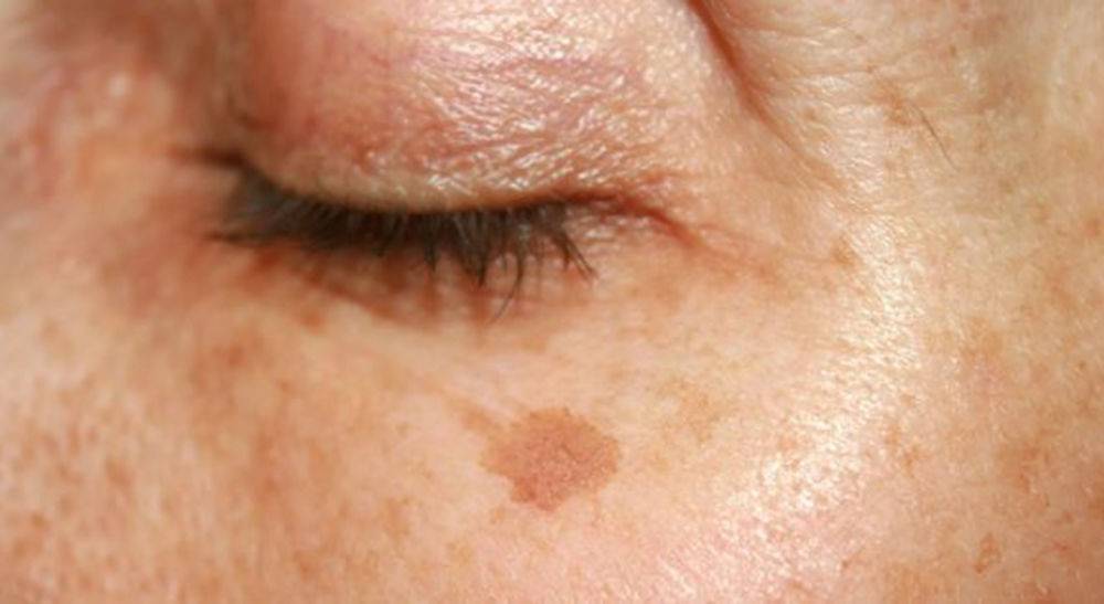 Пигментация кожи на лице | акриол про