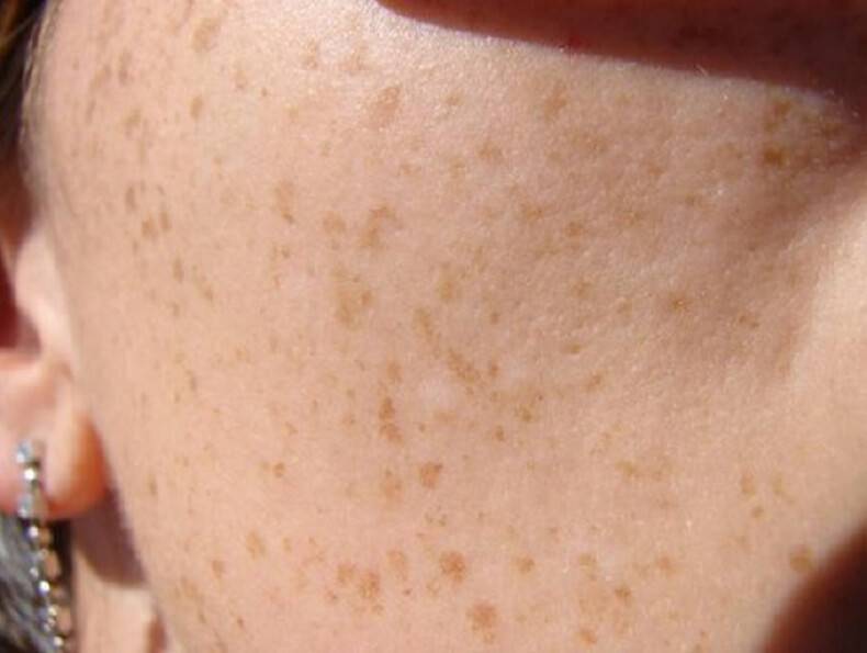 Гиперпигментация кожи: причины и методы лечения
