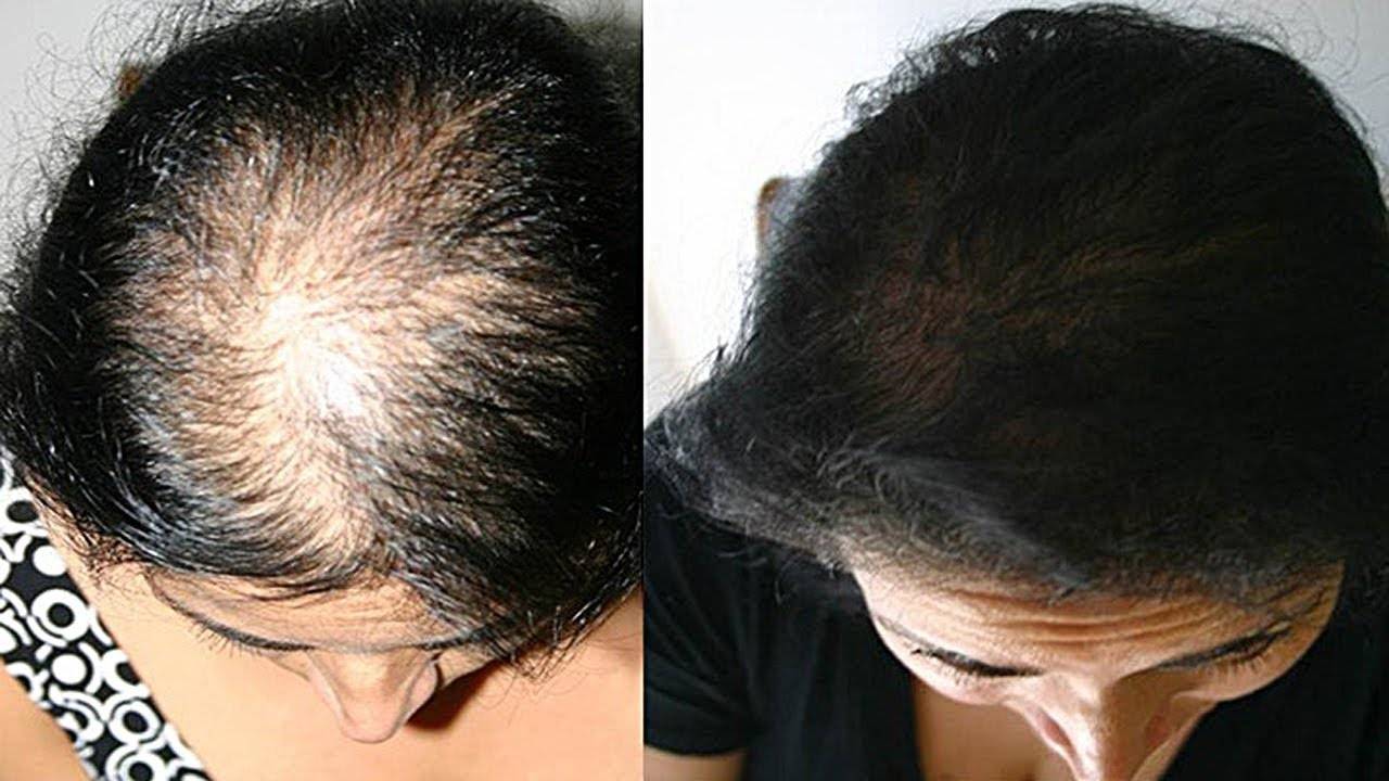 Как восстановить вырванные волосы на голове народными средствами