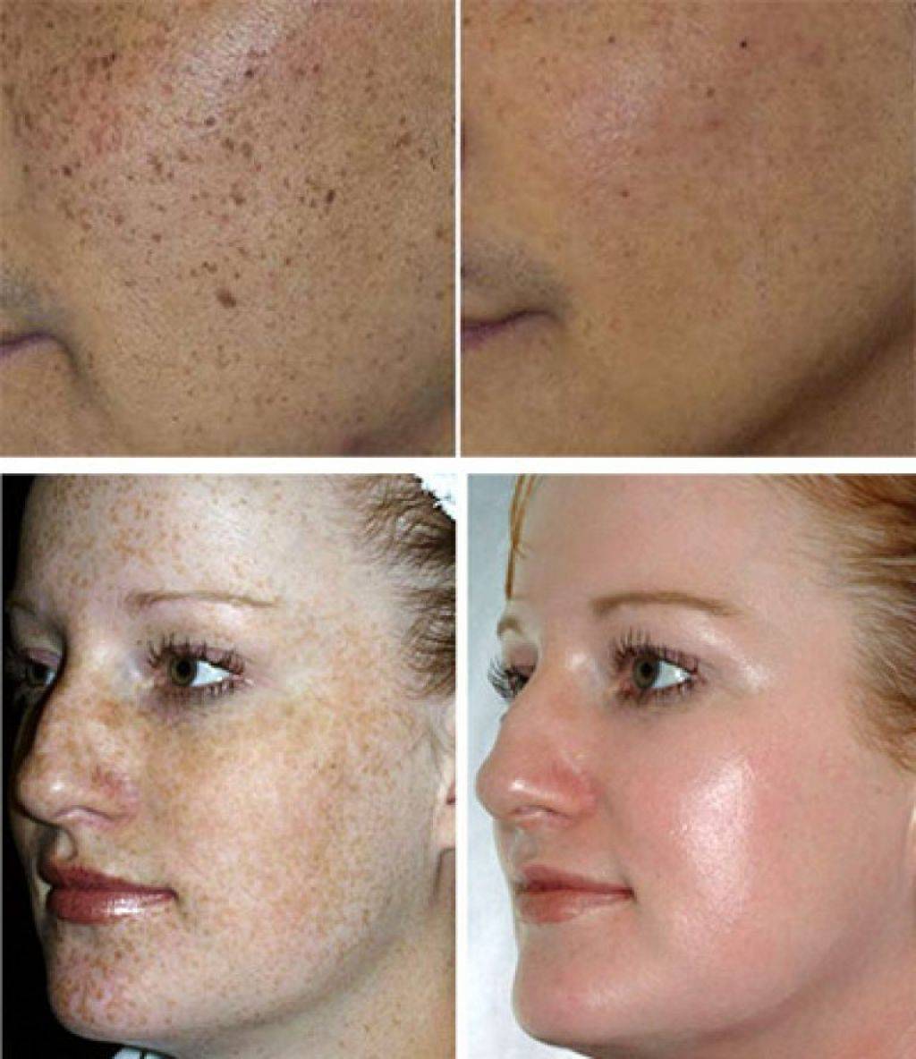 Гиперпигментация кожи - способы лечения