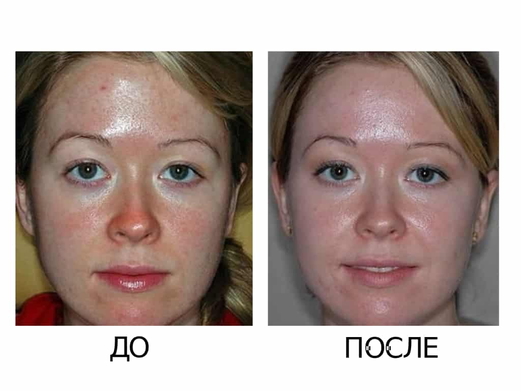 Как пилинг гликолевой кислотой справляется с несовершенствами кожи | блог expert clinics