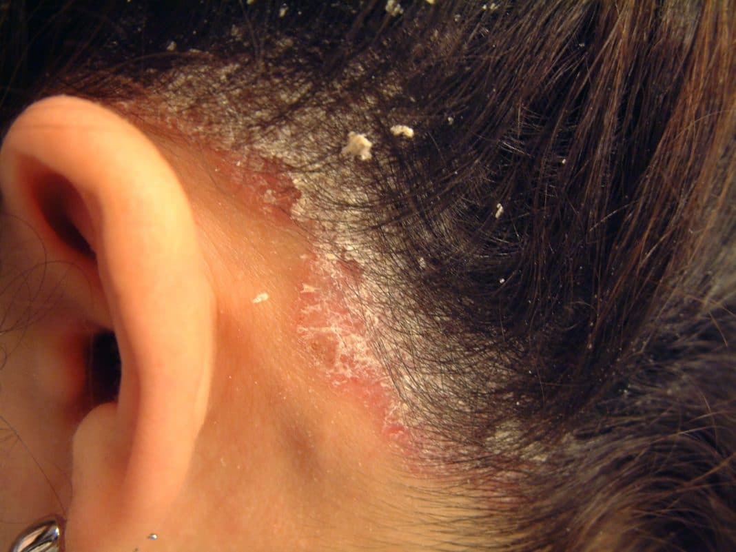 Бактериальные инфекции кожи: какие бывают, как лечить. правила профилактики