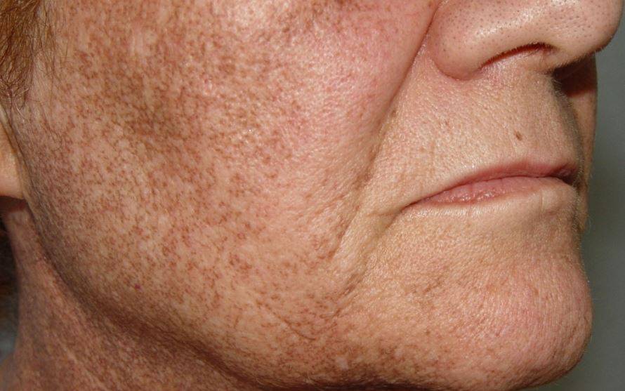 Гиперкератоз кожи: лечение, причины, признаки
