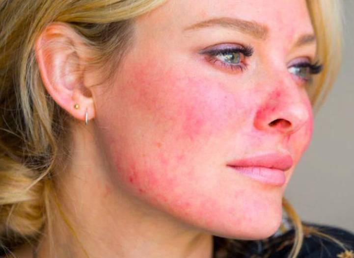 Аллергия на лице у взрослых и детей: причины, симптомы, лечение аллергии кожи лица