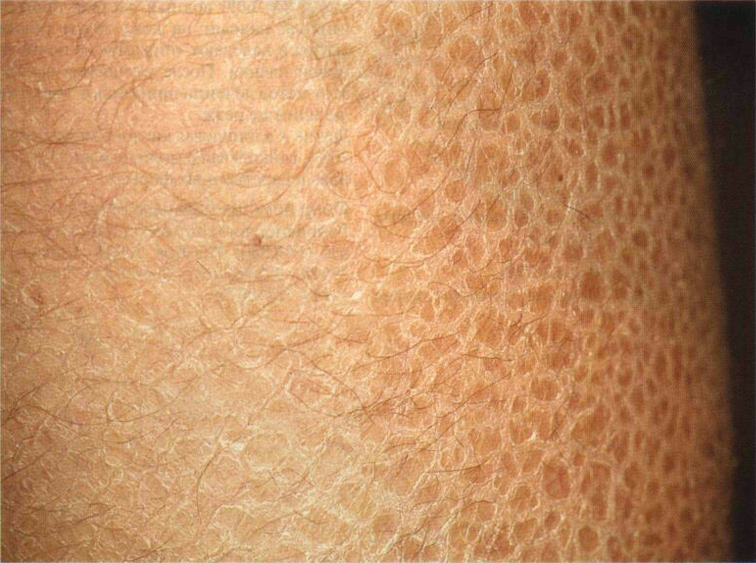 Гусиная кожа – фолликулярный гиперкератоз. фолликулярный кератоз у детей