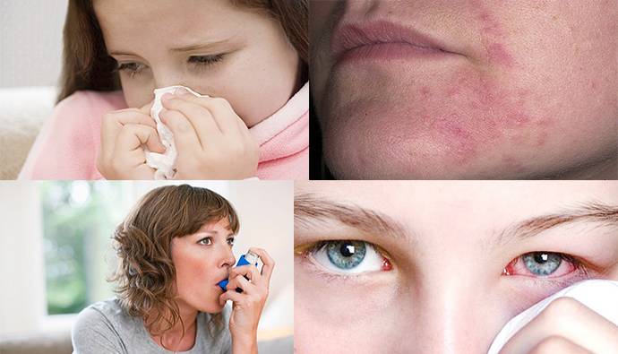 Аллергия на холод (холодовая крапивница) – эл клиника