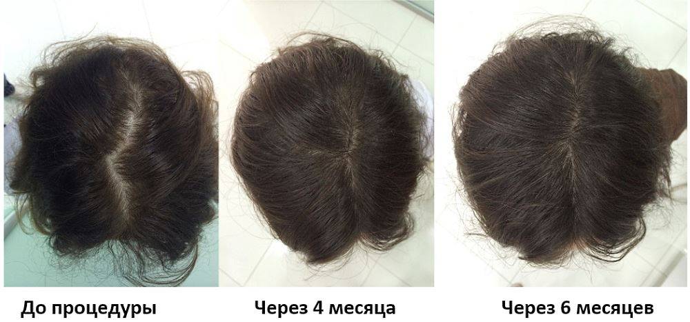 Мезотерапия для волос | суть методики мезотерапии для волосистой части головы