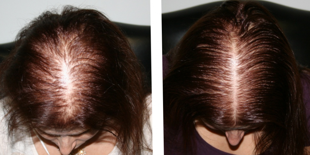 Плазмолифтинг – отзывы, фото до и после, для волос и лица