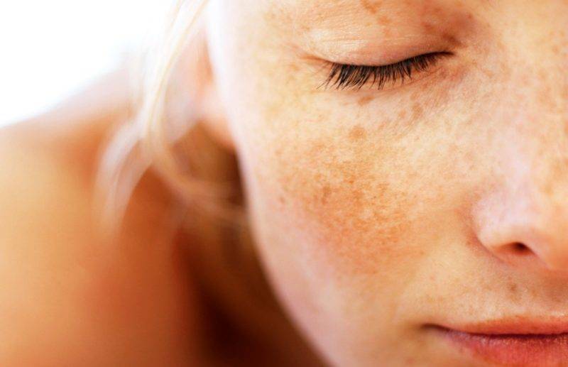Гиперпигментация кожи: причины и методы лечения