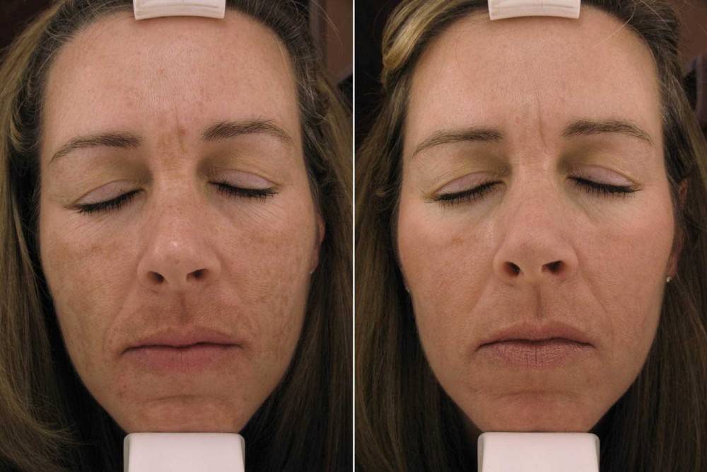 Как ухаживать за кожей после пилинга лица