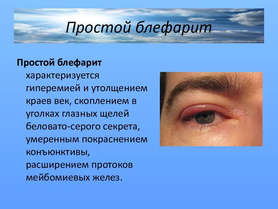 Блефарит: симптомы, причины, лечение этого заболевания глаз. - всё о зрении.