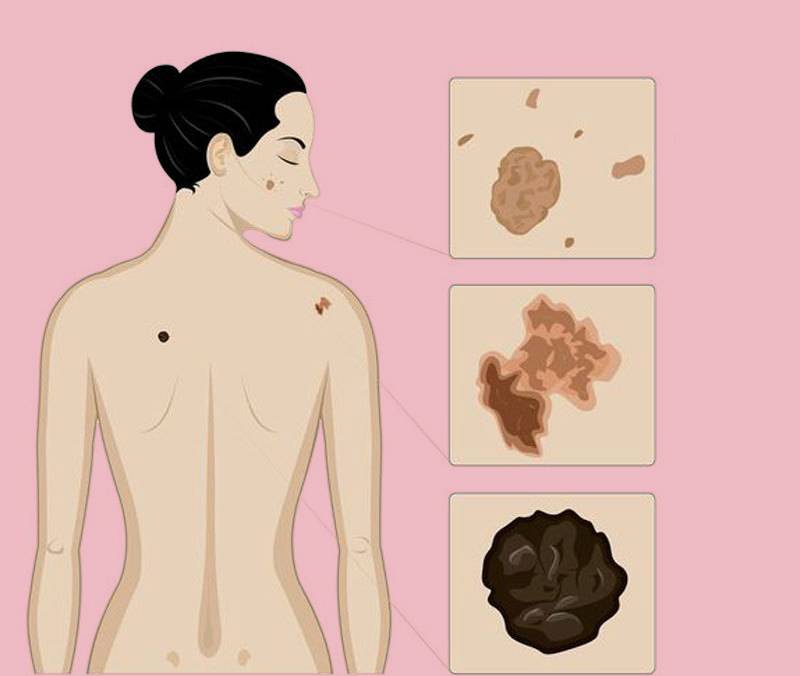 Меланома кожи: стадии, фото и процедура лечения. онкология